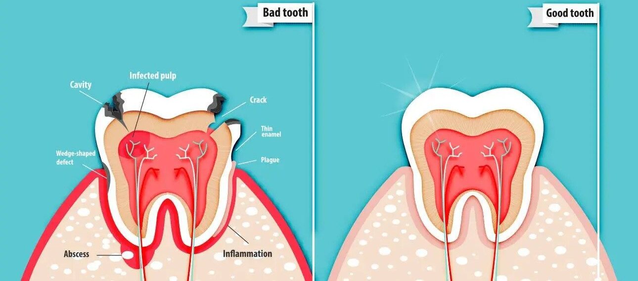 Pulpectomy Treatment at Dr. Changule's Face Clinic