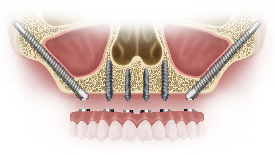 Zygomatic Pterygoid Implant