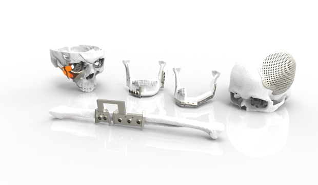 Patient Specific Implant