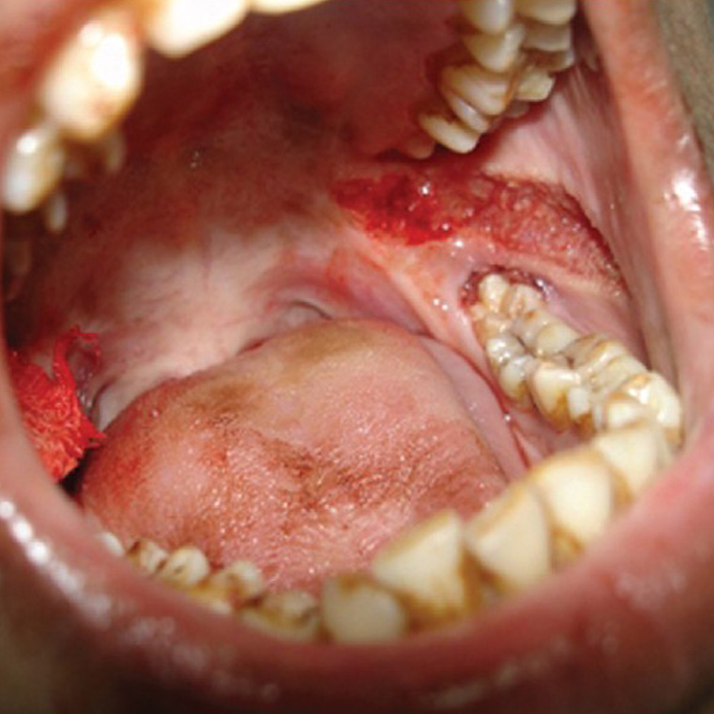 Treatment of Oral Submucous Fibrosis