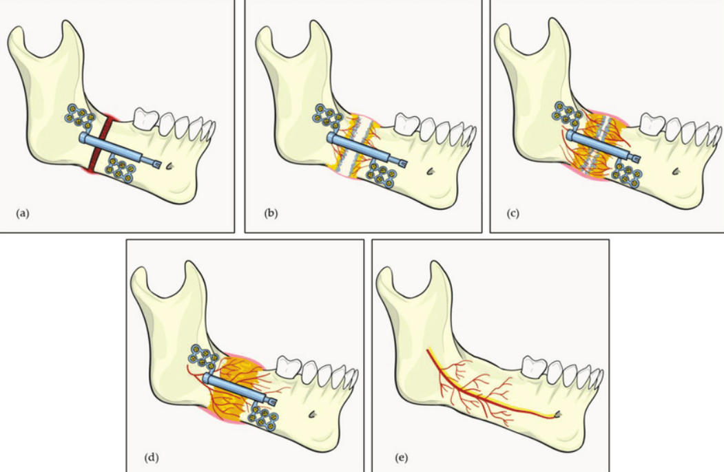 Distraction Osteogenesis