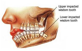 Minor Oral Surgeries