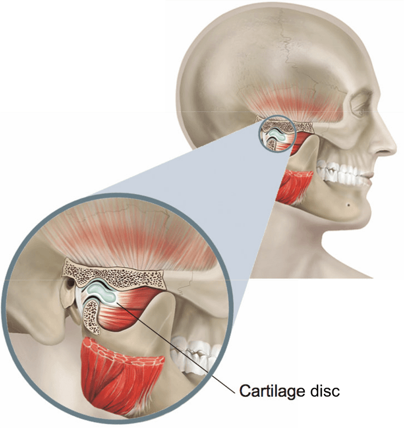 Temporo-Mandibular Joint Surgery