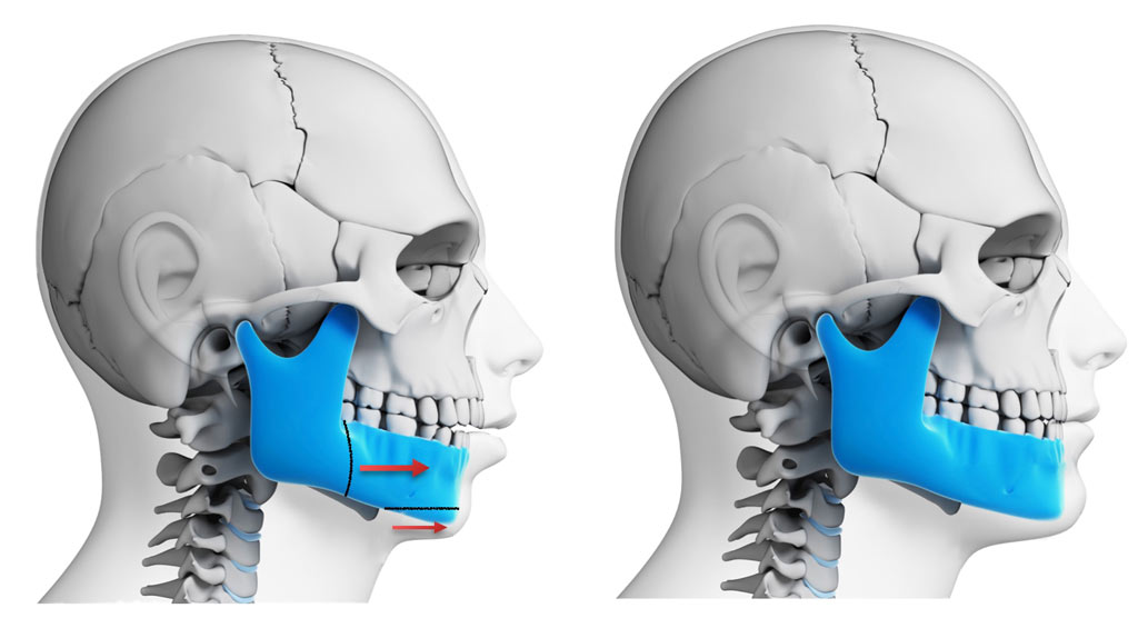 Orthognathic Surgery