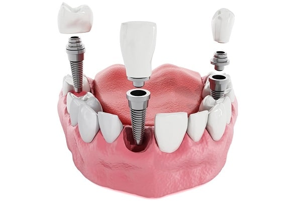 Conventional Implant