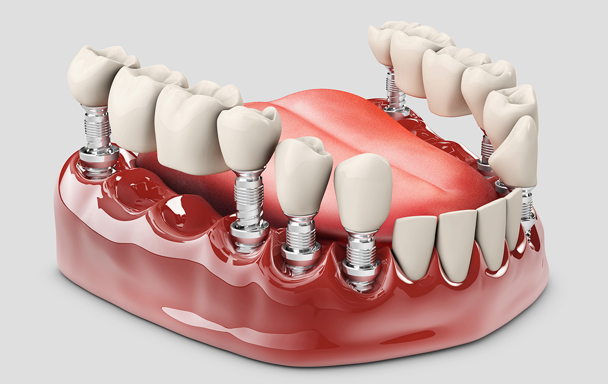 Fixed Partial Dentures