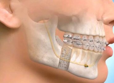 Understanding Oral and Maxillofacial Surgery An In-depth Exploration blog